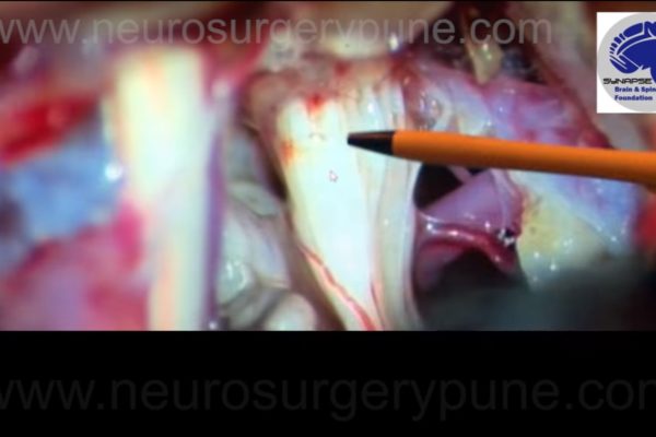 Trigeminal surgery